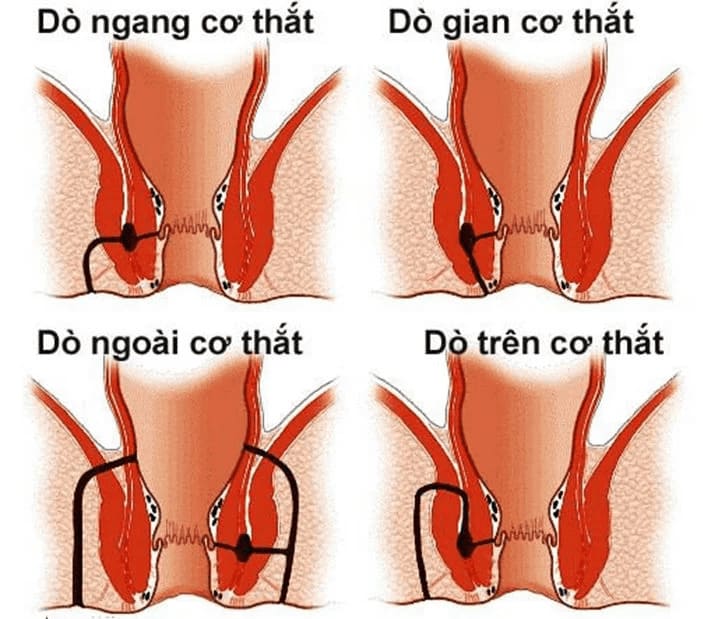 Bệnh rò hậu môn là gì?