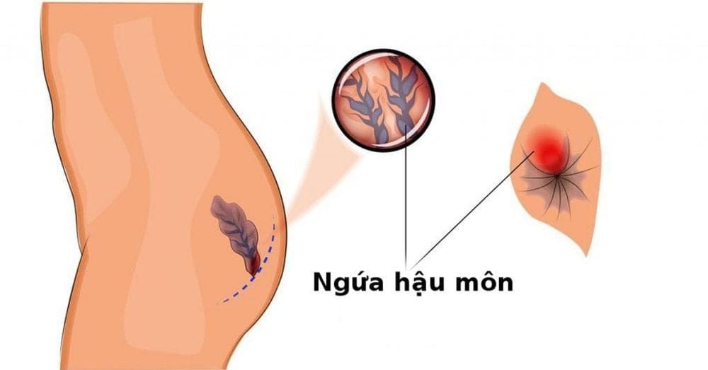 Bệnh rò hậu môn triệu chứng: Ngứa hậu môn