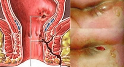 Tái phát rò hậu môn sau khi phẫu thuật