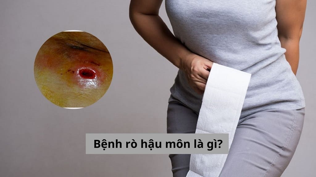 Bệnh rò hậu môn là gì?