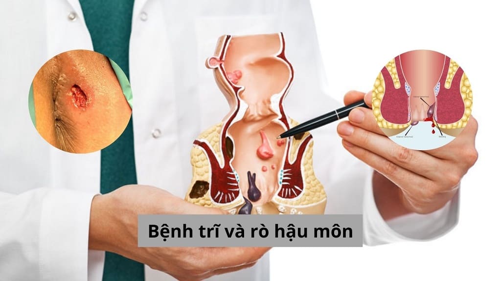 Bệnh trĩ và rò hậu môn