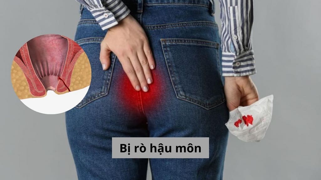 Bị rò hậu môn