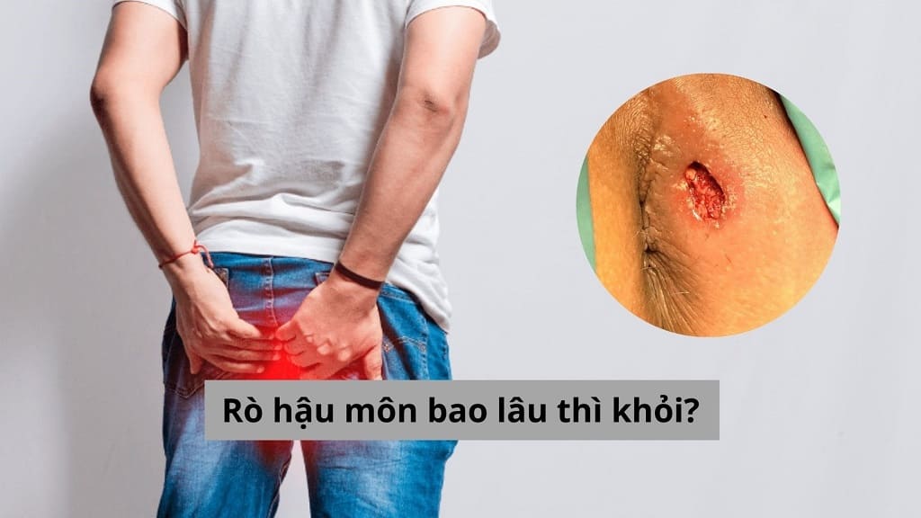 Rò hậu môn bao lâu thì khỏi?