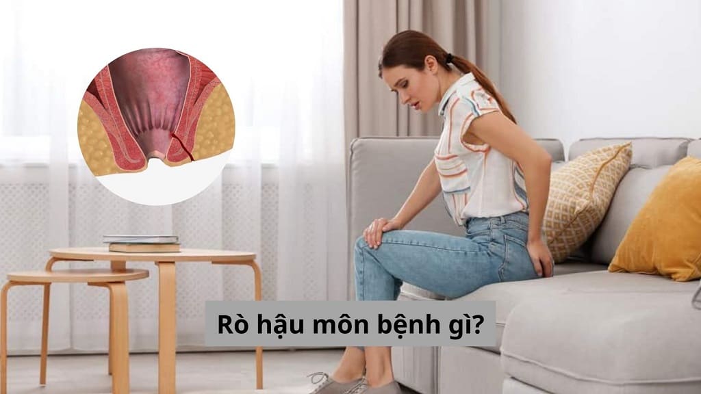 Rò hậu môn bệnh gì?