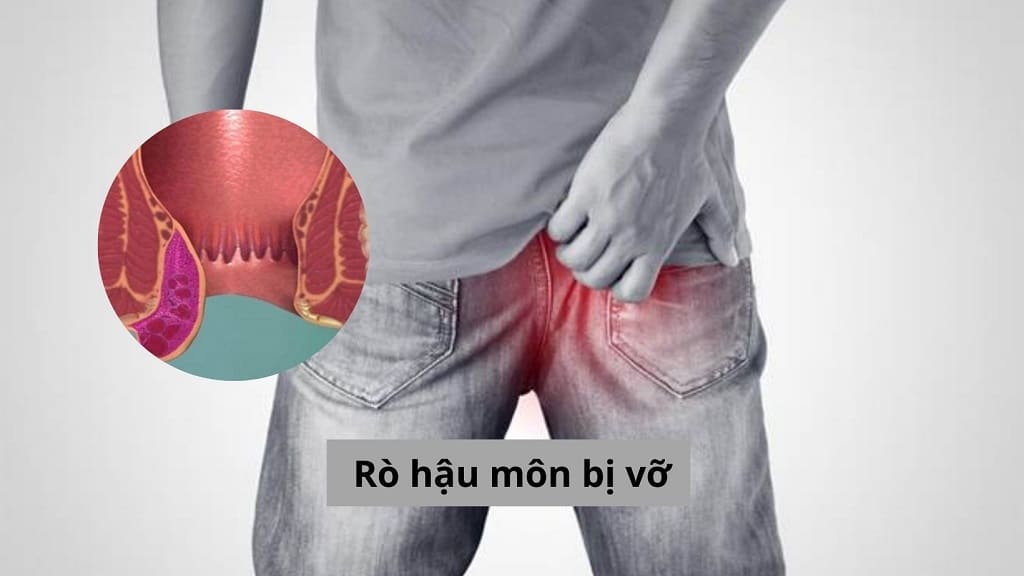 Rò hậu môn bị vỡ