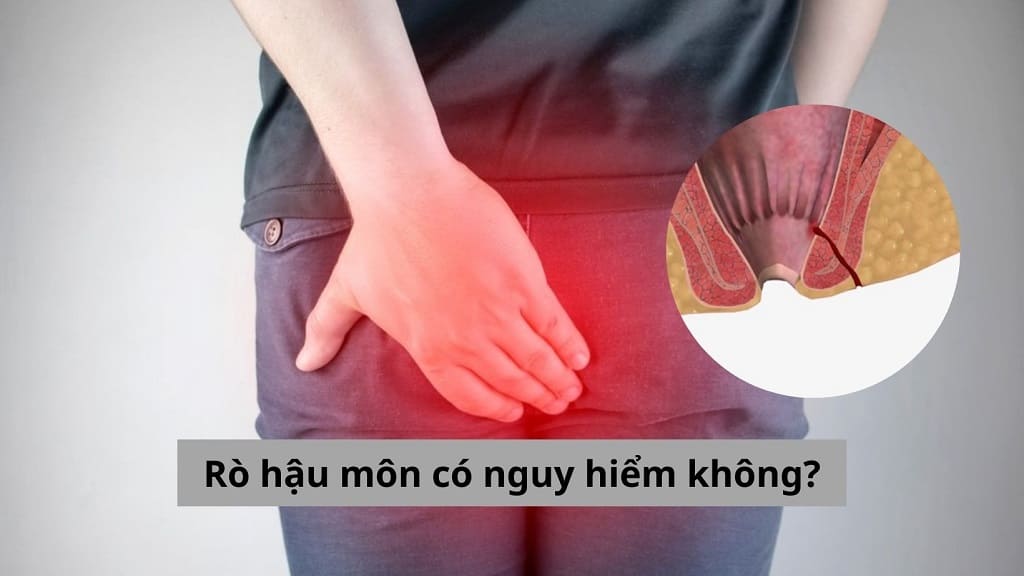 Rò hậu môn có nguy hiểm không?