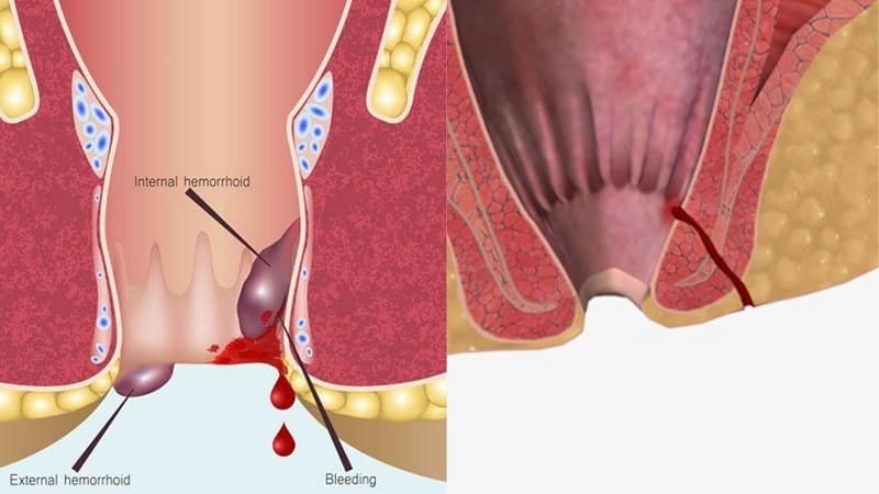Bệnh trĩ và rò hậu môn