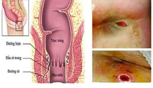 Các yếu tố làm tăng nguy cơ mắc rò hậu môn 