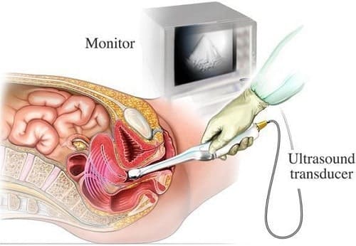 Chẩn đoán rò hậu môn