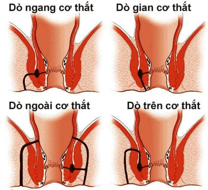 Vị trí và độ phức tạp của rò