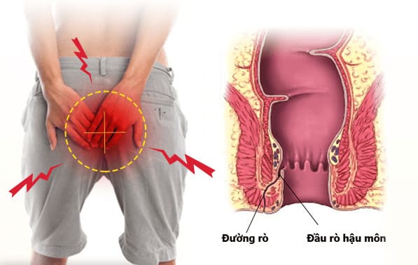 Mức độ nguy hiểm của rò hậu môn