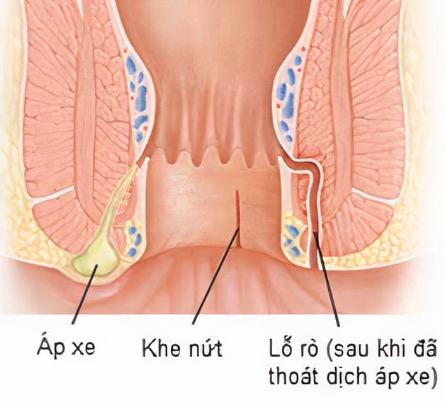 Rò hậu môn