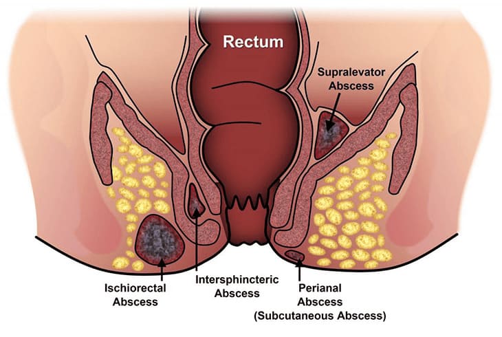 Rò hậu môn có nguy hiểm không? Gây ra tổn hại như thế nào?