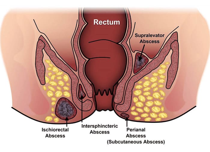 Nguyên nhân bị rò hậu môn đơn giản