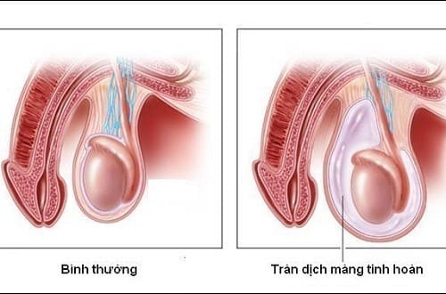 Sưng tinh hoàn do tràn dịch màng tinh