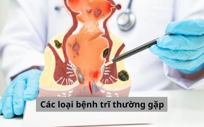 Bác sĩ chuyên khoa chỉ ra các loại bệnh trĩ thường gặp cần nắm rõ