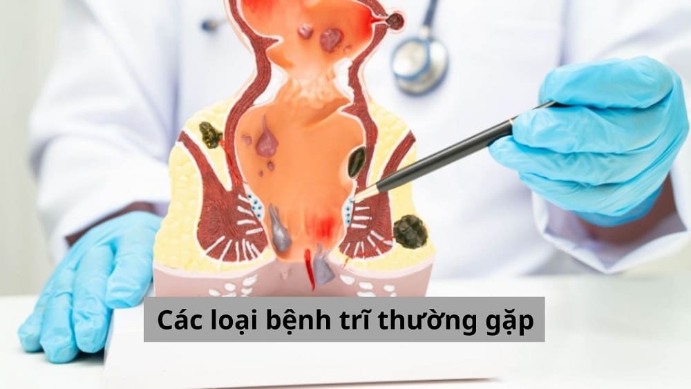 Các loại bệnh trĩ thường gặp