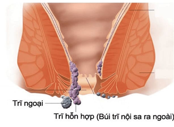 Các loại bệnh trĩ thường gặp: Trĩ hỗn hợp