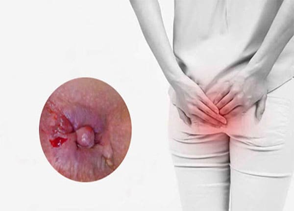 Tổng quan về bệnh trĩ