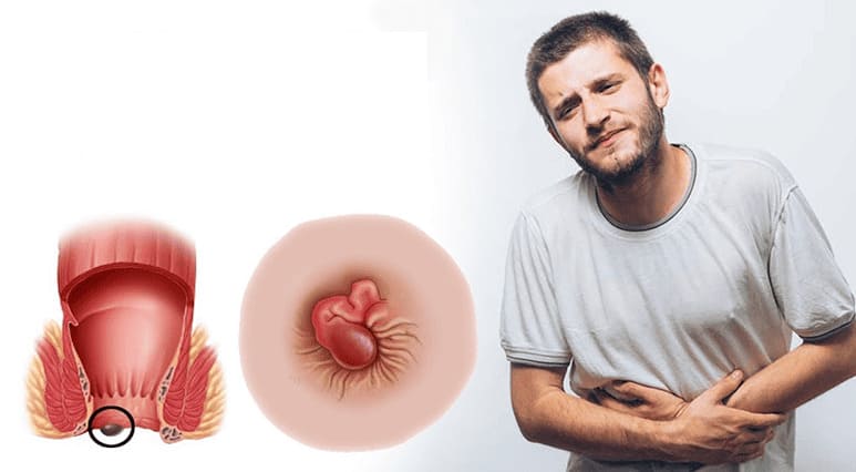 Tìm hiểu tổng quan về bệnh trĩ