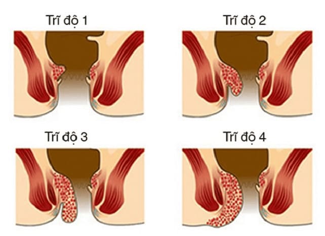 Triệu chứng bệnh trĩ nội