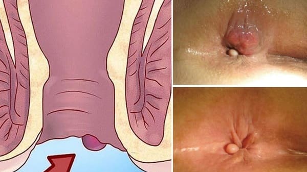Triệu chứng bệnh trĩ ngoại