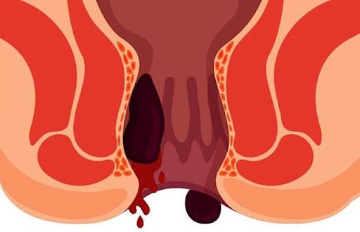 Biến chứng bệnh trĩ