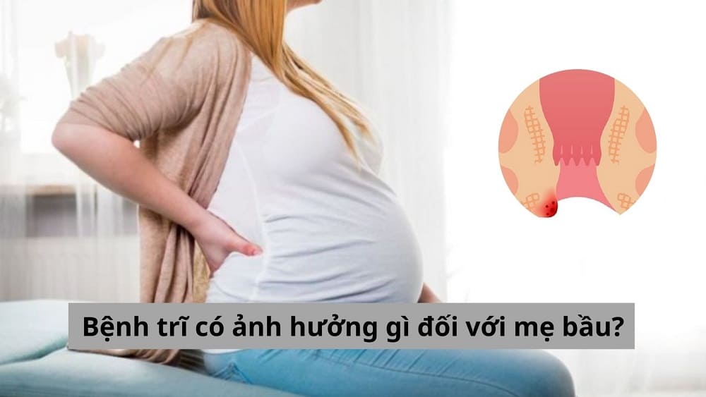 Bệnh trĩ có ảnh hưởng gì đối với mẹ bầu
