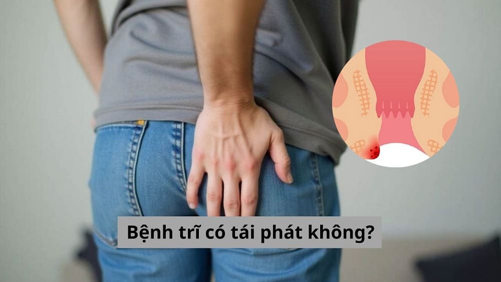 Bệnh trĩ có tái phát không?