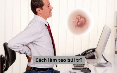 Tổng hợp các cách làm teo búi trĩ nhanh chóng và hiệu quả