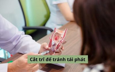 Phương pháp cắt trĩ để tránh tái phát, an toàn và hiệu quả