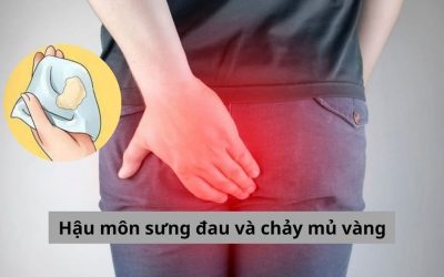 Lý giải hậu môn sưng đau và chảy mủ vàng có nguy hiểm không?