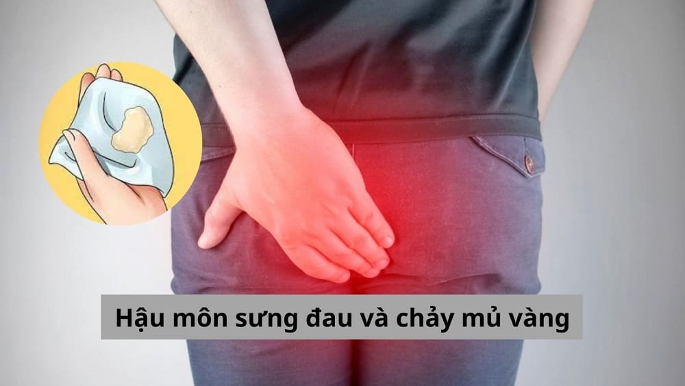 Hậu môn sưng đau và chảy mủ vàng