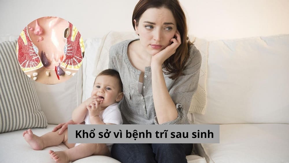Khổ sở vì bệnh trĩ sau sinh
