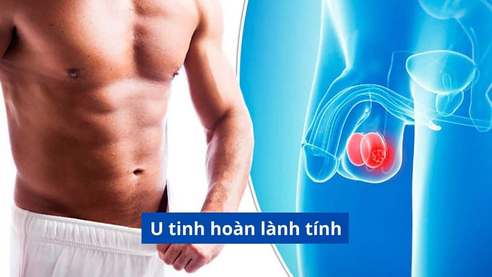 U tinh hoàn lành tính