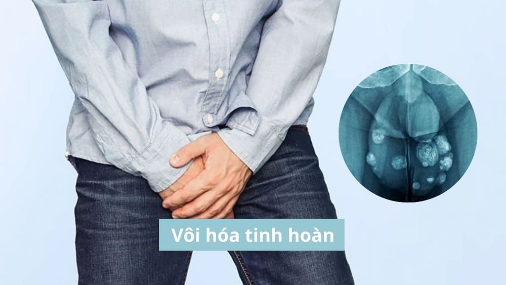 Vôi hóa tinh hoàn
