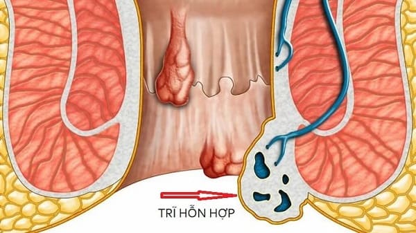 Tìm hiểu các cấp độ của bệnh trĩ