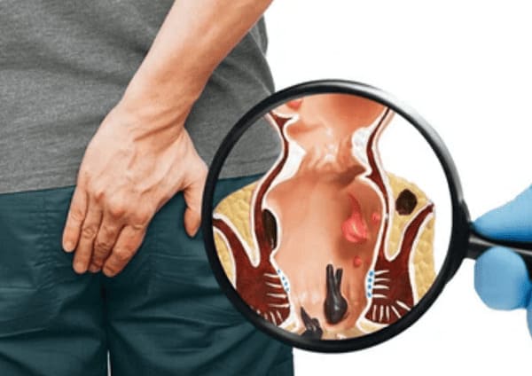 Mức độ nguy hiểm của bệnh trĩ đe dọa đến sức khỏe người bệnh