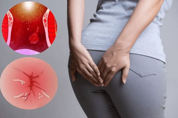 Bệnh trĩ có ảnh hưởng đến sinh lý không?