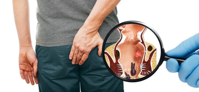 Lưu ý sau khi điều trị bệnh trĩ tránh biến chứng
