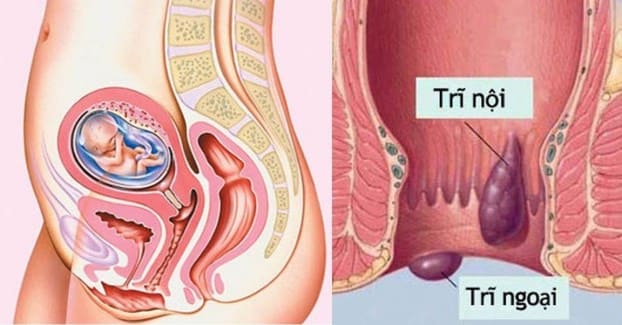 Tại sao phụ nữ khi mang thai thường bị bệnh trĩ?