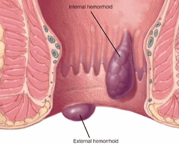 Trĩ là hiện tượng bệnh lý gì?