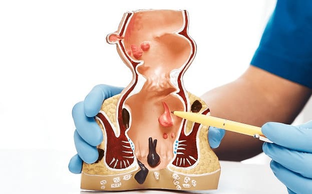 Nguyên nhân dẫn đến tình trạng trĩ tái phát là gì?
