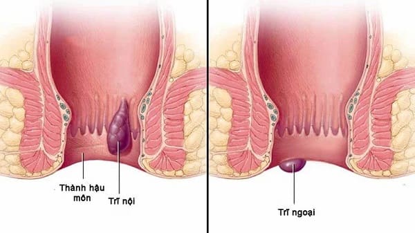 Nhận biết triệu chứng và nguyên nhân bệnh trĩ