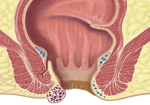 Dấu hiệu nhận biết chính xác tình trạng bệnh trĩ nhẹ