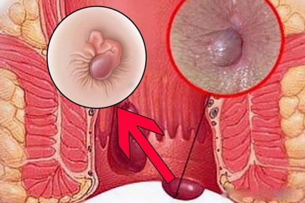 Búi trĩ xuất hiện khi nào?