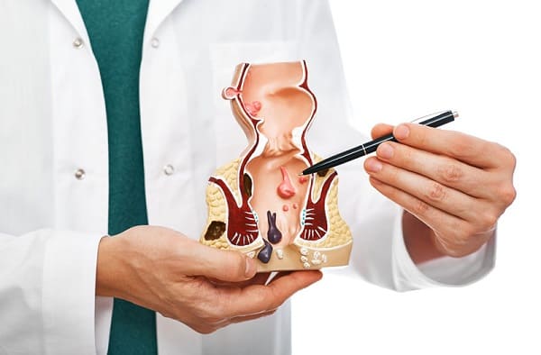 Khi nào cần can thiệp ngoại khoa để làm teo búi trĩ