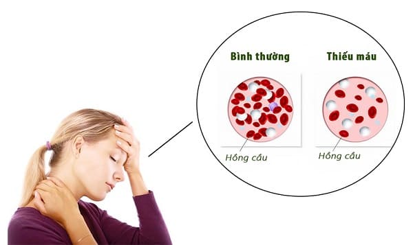 Biến chứng bệnh trĩ - Thiếu máu nghiêm trọng