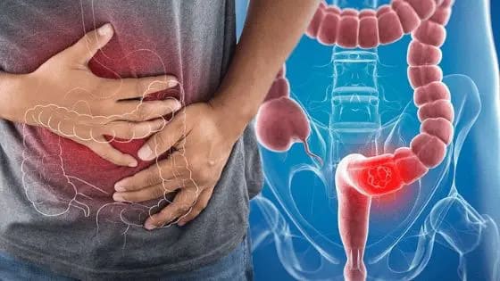 Có nên phẫu thuật cắt trĩ không? - Biến chứng ung thư trực tràng
