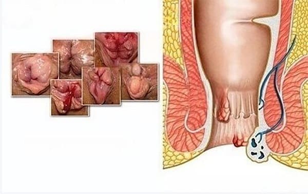 Khi nào cần phẫu thuật cắt trĩ?